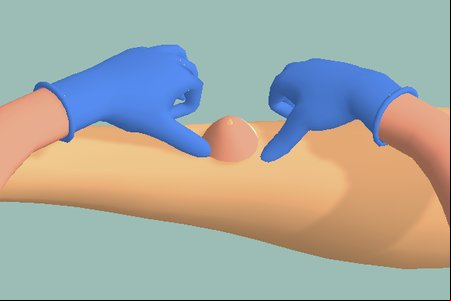Pimple Squeeze